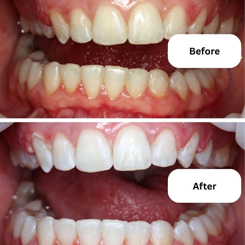 BVSA (20) NanoSmile Set