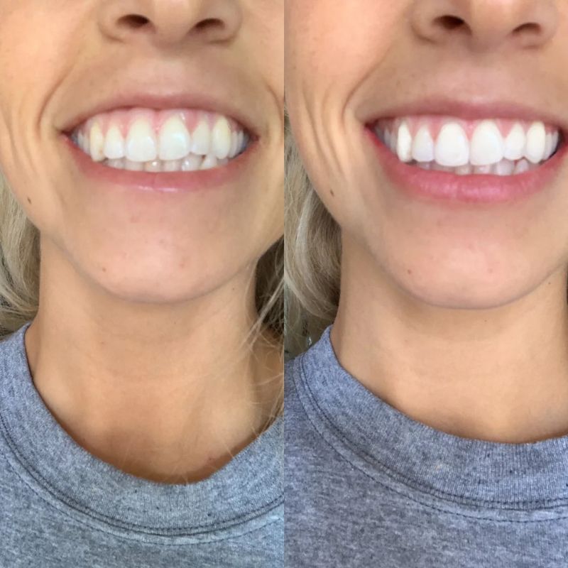 BVSA (26) NanoSmile Set