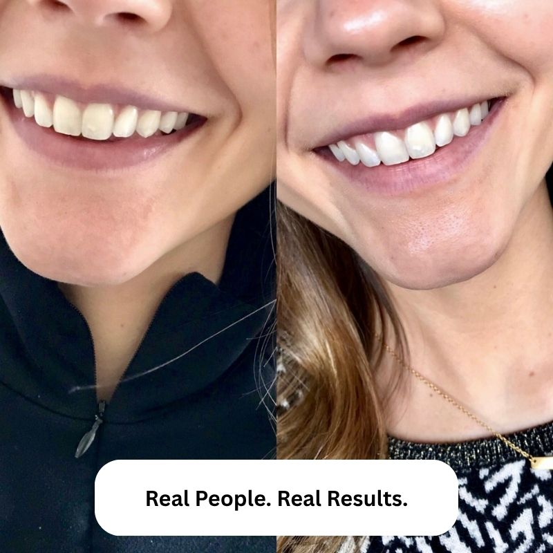 BVSA (30) NanoSmile Set